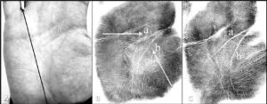Domany et al 2018 palmar crease abnormalities