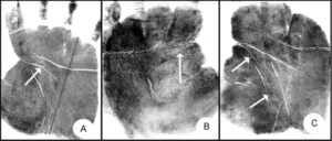 Shamir et al 2015 palmar crease abnormalities