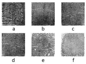 Dermatoglyphic fingerprint patterns