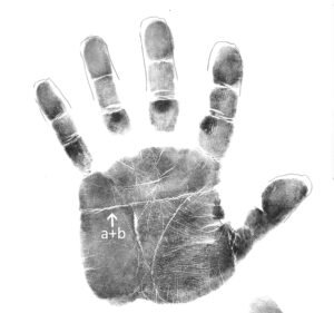 Simian line compared to normal palmar lines