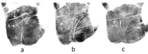Three examples of palmar line patterns